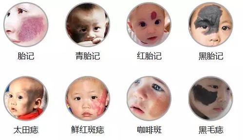 国内代孕宝宝为什么有胎记